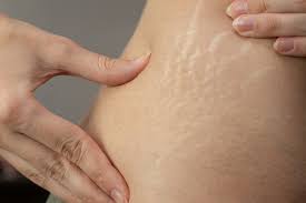 stretch mark (alodokter)