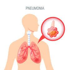 Pneumonia