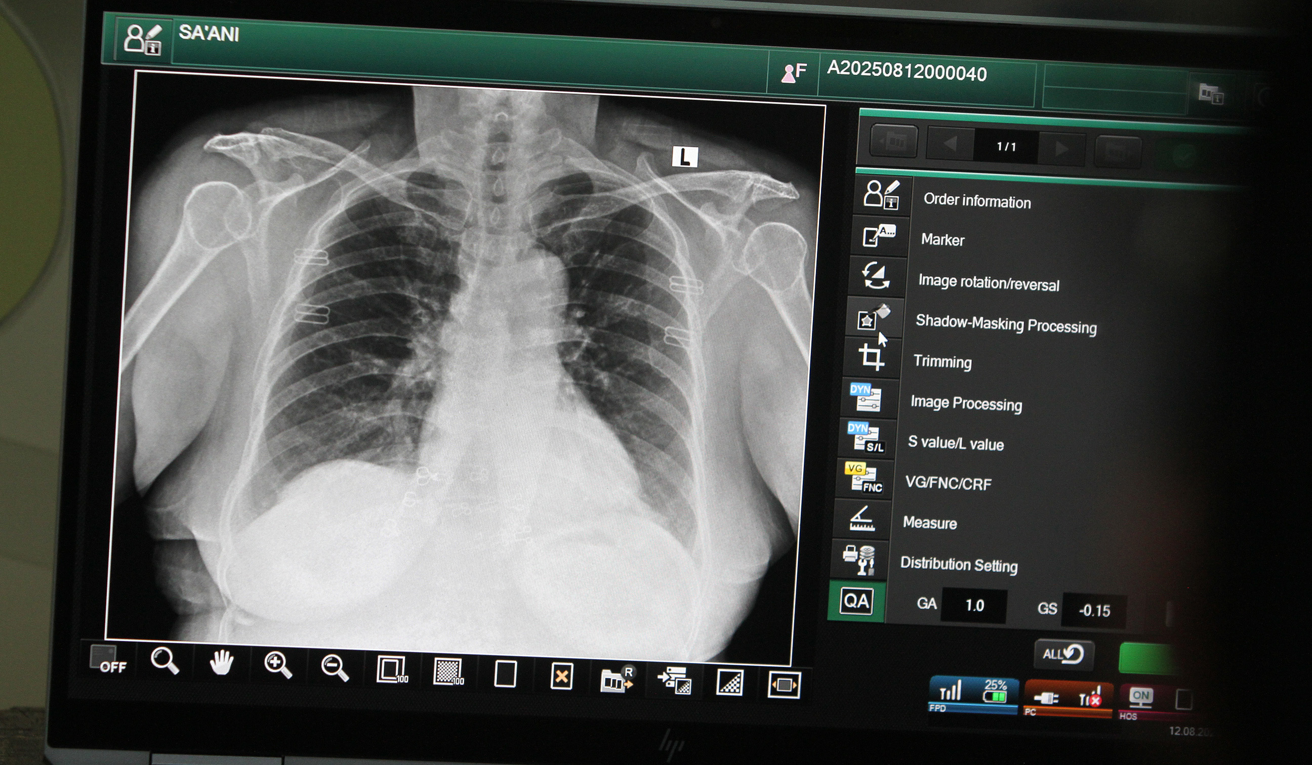 Pemprov DKI gelar skrining TBC. (Agus Priatna/SinPo.id)